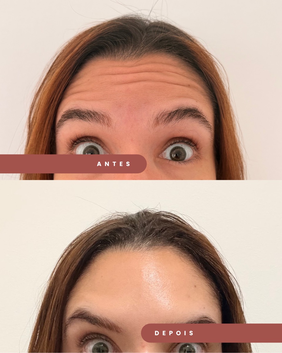 Botox antes e depois