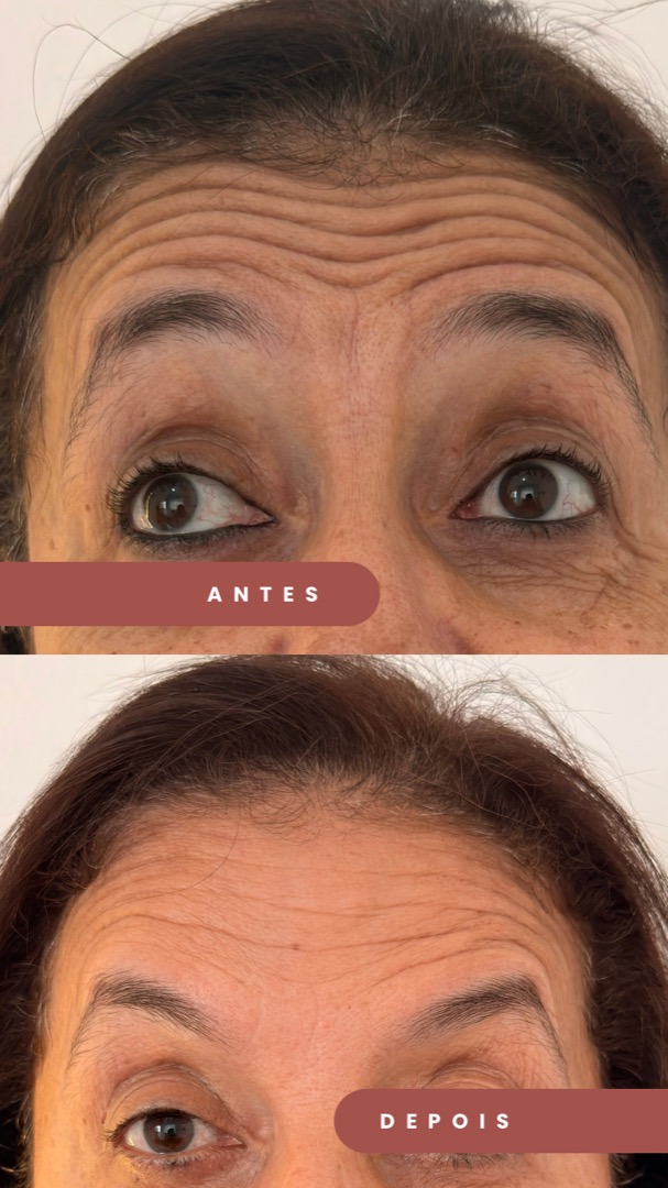 Botox antes e depois